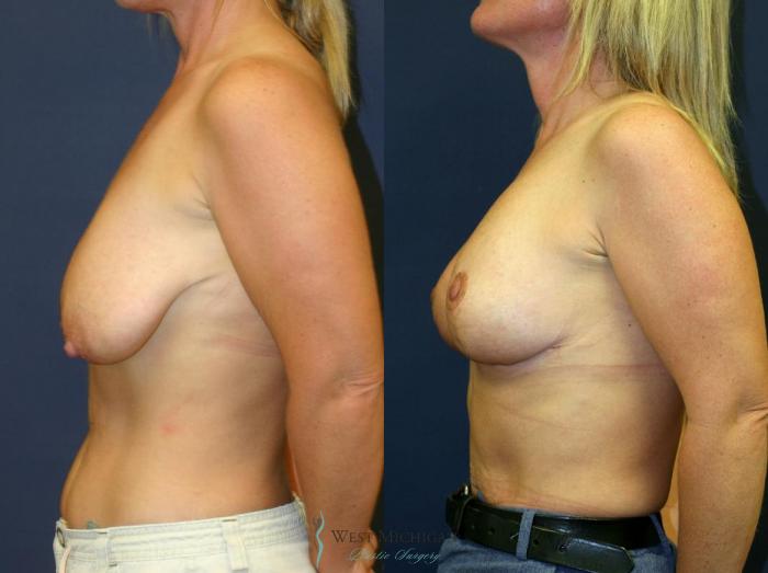 Before & After Breast Lift Case 8946 View #2 View in Portage, Kalamazoo, Battle Creek, Michigan