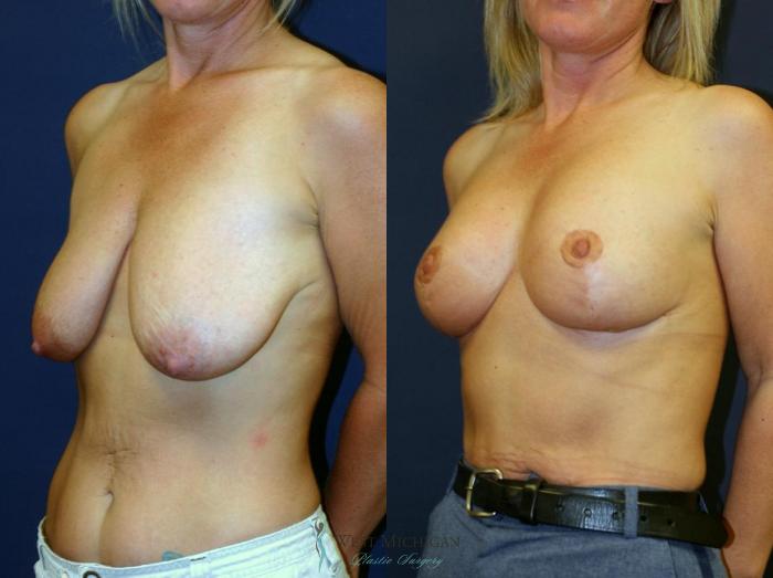 Before & After Breast Lift Case 8946 View #3 View in Portage, Kalamazoo, Battle Creek, Michigan