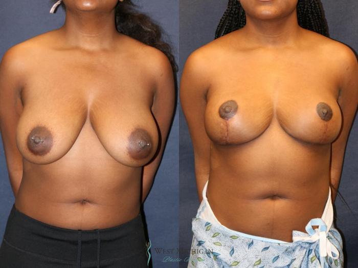 Before & After Breast Lift Case 8947 View #1 View in Portage, Kalamazoo, Battle Creek, Michigan