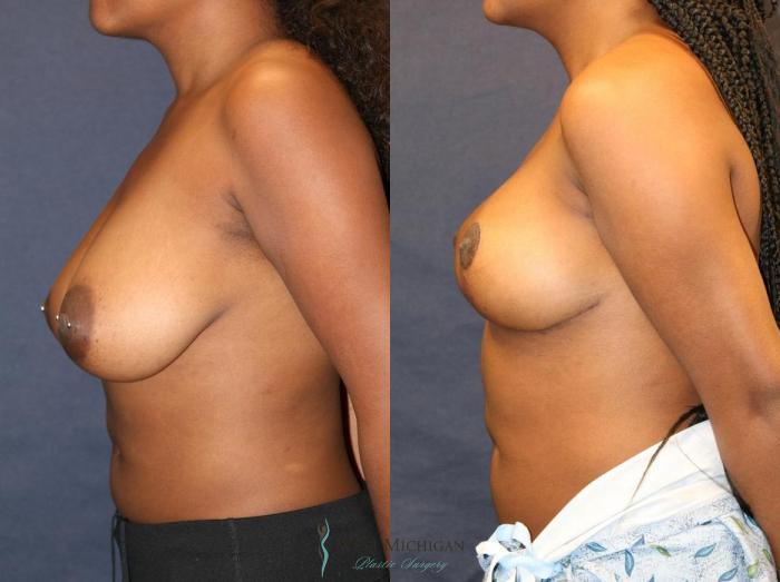 Before & After Breast Lift Case 8947 View #2 View in Portage, Kalamazoo, Battle Creek, Michigan