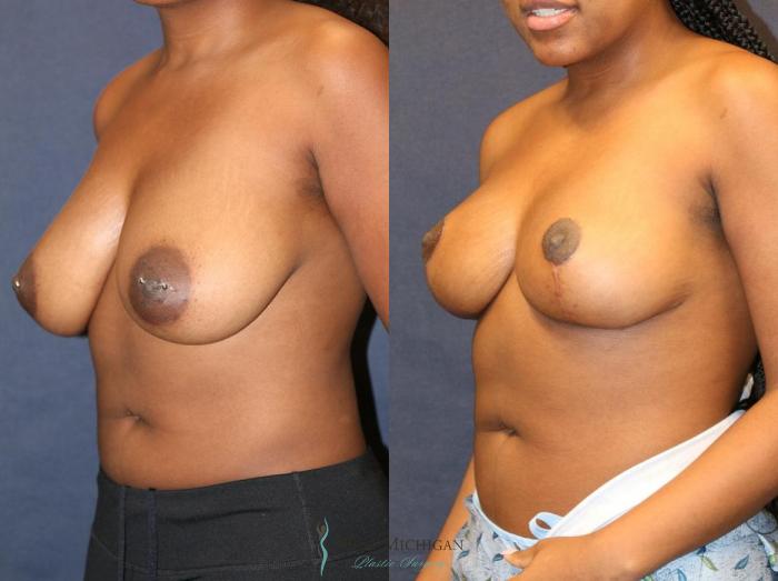 Before & After Breast Lift Case 8947 View #3 View in Portage, Kalamazoo, Battle Creek, Michigan