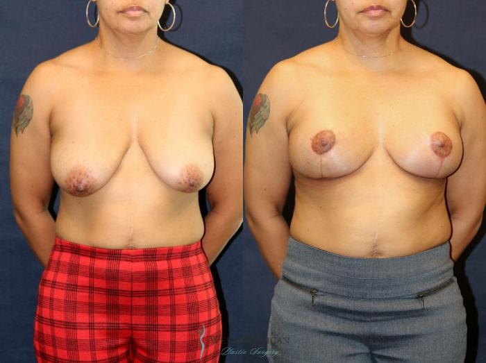 Before & After Breast Lift Case 8948 View #1 View in Portage, Kalamazoo, Battle Creek, Michigan