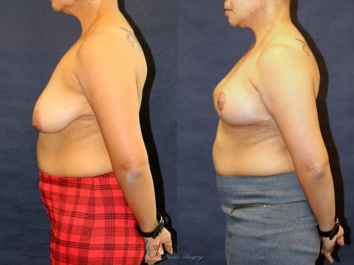 Before & After Breast Lift Case 8948 View #2 View in Portage, Kalamazoo, Battle Creek, Michigan