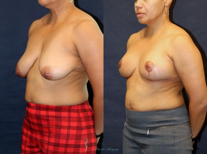 Before & After Breast Lift Case 8948 View #3 View in Portage, Kalamazoo, Battle Creek, Michigan