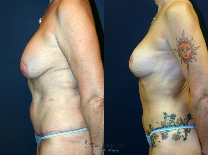Before & After Breast Lift Case 9144 View #2 View in Portage, Kalamazoo, Battle Creek, Michigan