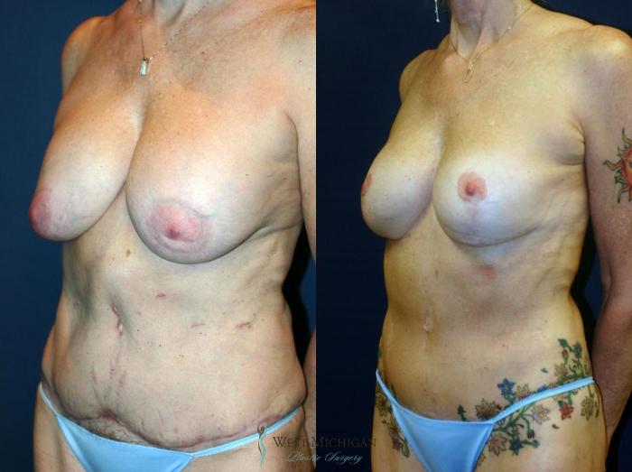 Before & After Breast Lift Case 9144 View #3 View in Portage, Kalamazoo, Battle Creek, Michigan
