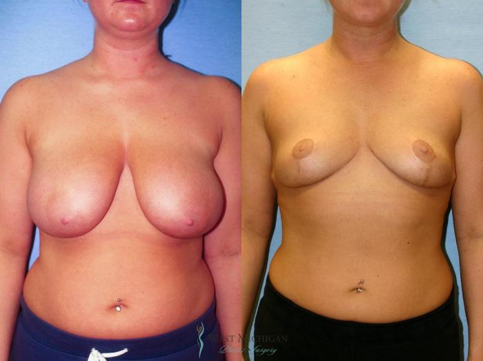 Before & After Breast Lift Case 9145 View #1 View in Portage, Kalamazoo, Battle Creek, Michigan