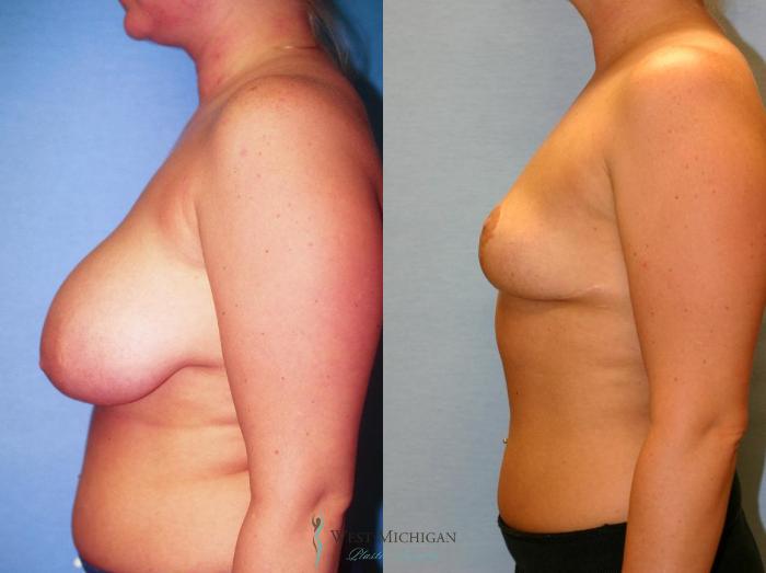 Before & After Breast Lift Case 9145 View #2 View in Portage, Kalamazoo, Battle Creek, Michigan