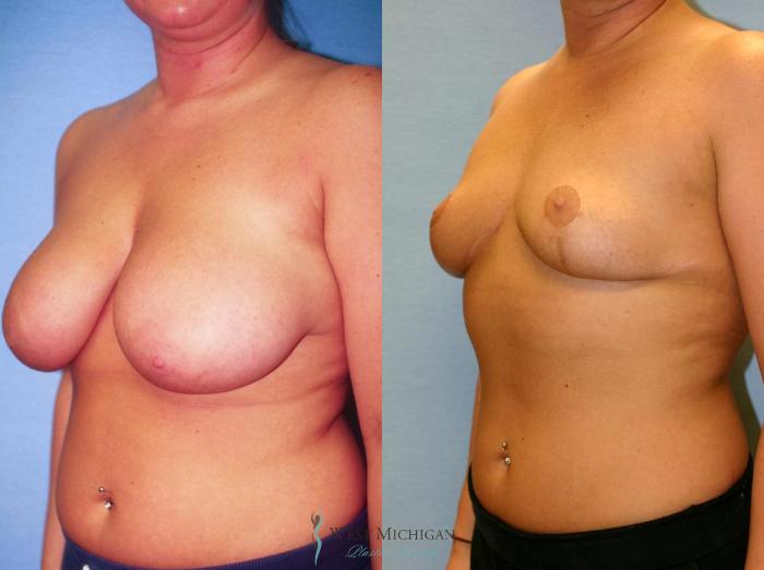 Before & After Breast Lift Case 9145 View #3 View in Portage, Kalamazoo, Battle Creek, Michigan