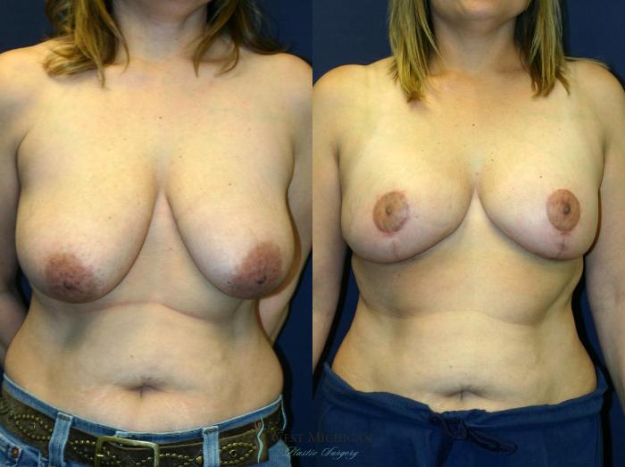 Before & After Breast Lift Case 9146 View #1 View in Portage, Kalamazoo, Battle Creek, Michigan