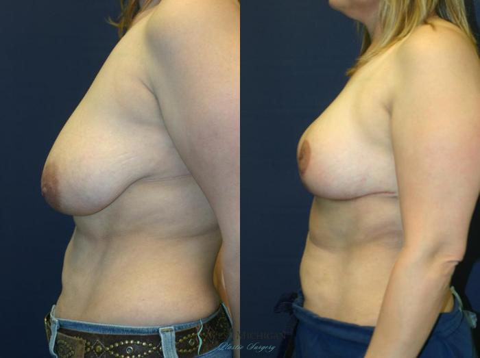 Before & After Breast Lift Case 9146 View #2 View in Portage, Kalamazoo, Battle Creek, Michigan