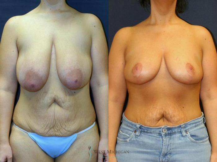 Before & After Breast Lift Case 9147 View #1 View in Portage, Kalamazoo, Battle Creek, Michigan