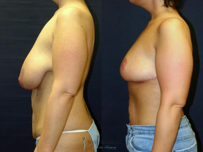 Before & After Breast Lift Case 9147 View #2 View in Portage, Kalamazoo, Battle Creek, Michigan