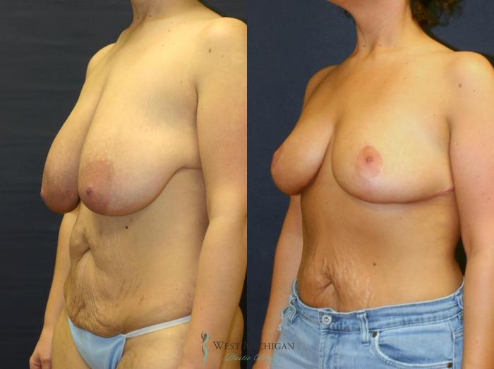 Before & After Breast Lift Case 9147 View #3 View in Portage, Kalamazoo, Battle Creek, Michigan
