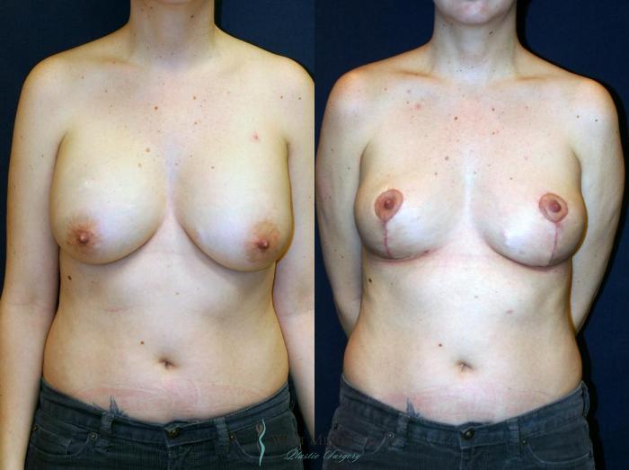 Before & After Breast Lift Case 9149 View #1 View in Portage, Kalamazoo, Battle Creek, Michigan