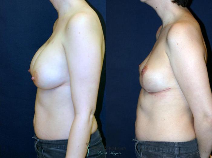 Before & After Breast Lift Case 9149 View #2 View in Portage, Kalamazoo, Battle Creek, Michigan