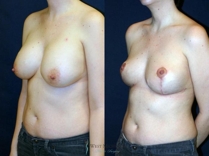 Before & After Breast Lift Case 9149 View #3 View in Portage, Kalamazoo, Battle Creek, Michigan