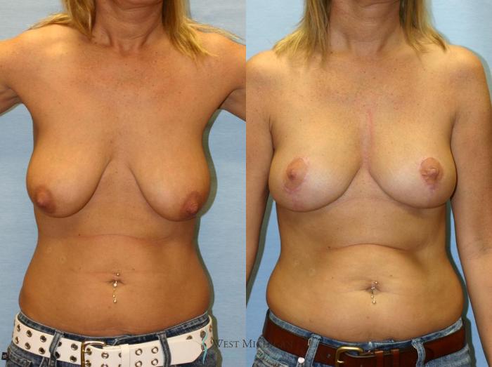 Before & After Breast Lift Case 9150 View #1 View in Portage, Kalamazoo, Battle Creek, Michigan