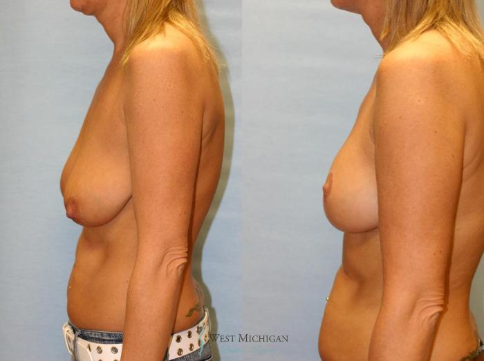 Before & After Breast Lift Case 9150 View #2 View in Portage, Kalamazoo, Battle Creek, Michigan