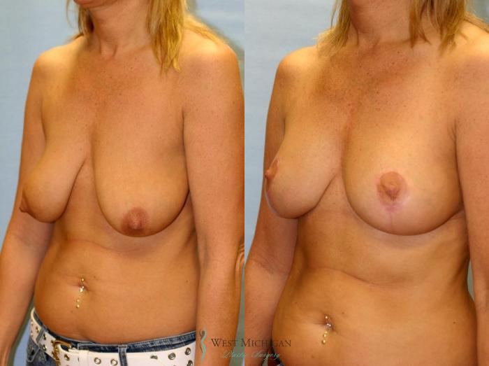 Before & After Breast Lift Case 9150 View #3 View in Portage, Kalamazoo, Battle Creek, Michigan