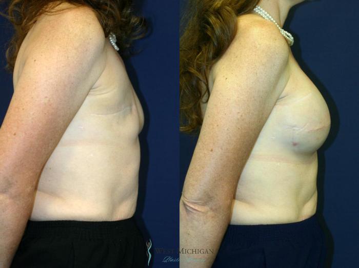 Before & After Breast Reconstruction Case 8727 View #2 View in Portage, Kalamazoo, Battle Creek, Michigan