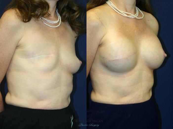 Before & After Breast Reconstruction Case 8727 View #3 View in Portage, Kalamazoo, Battle Creek, Michigan