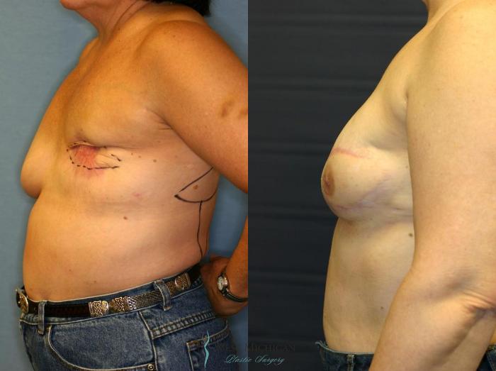 Before & After Breast Reconstruction Case 8936 View #2 View in Portage, Kalamazoo, Battle Creek, Michigan