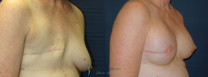 Before & After Breast Reconstruction Case 8937 View #3 View in Portage, Kalamazoo, Battle Creek, Michigan