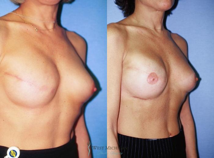 Before & After Breast Reconstruction Case 8939 View #2 View in Portage, Kalamazoo, Battle Creek, Michigan
