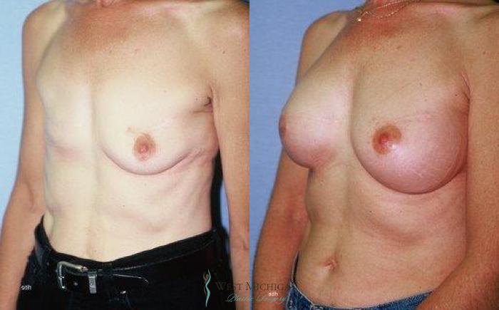 Before & After Breast Reconstruction Case 8940 View #2 View in Portage, Kalamazoo, Battle Creek, Michigan