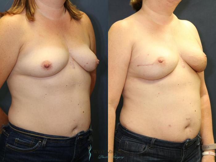 Before & After Breast Reconstruction Case 8941 View #3 View in Portage, Kalamazoo, Battle Creek, Michigan