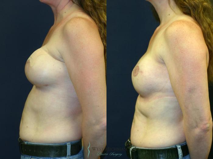 Before & After Breast Reconstruction Case 8942 View #2 View in Portage, Kalamazoo, Battle Creek, Michigan