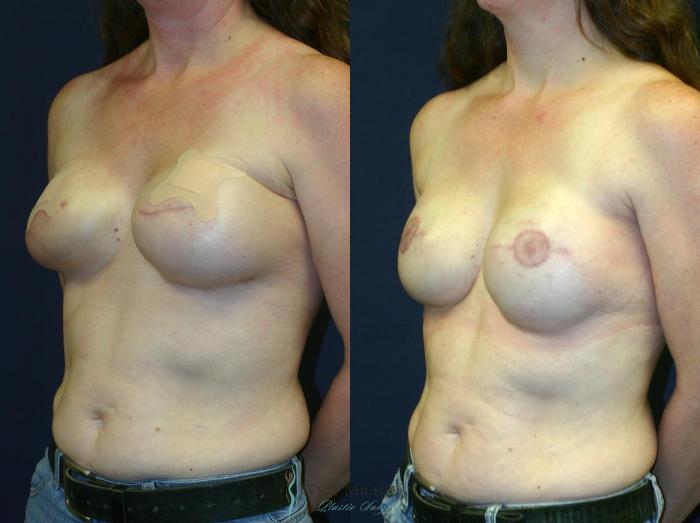 Before & After Breast Reconstruction Case 8942 View #3 View in Portage, Kalamazoo, Battle Creek, Michigan