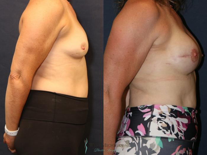 Before & After Breast Reconstruction Case 8943 View #2 View in Portage, Kalamazoo, Battle Creek, Michigan