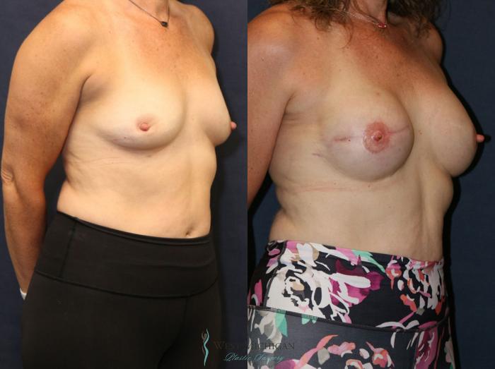 Before & After Breast Reconstruction Case 8943 View #3 View in Portage, Kalamazoo, Battle Creek, Michigan