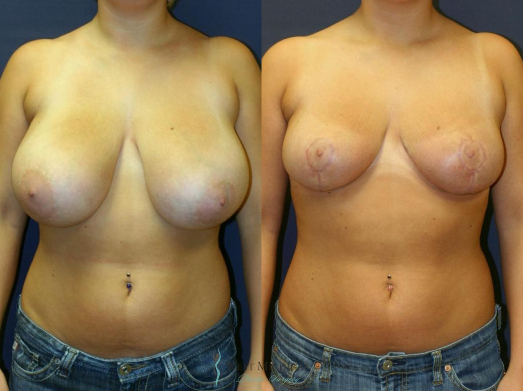 Before & After Breast Reduction Case 8728 View #1 View in Portage, Kalamazoo, Battle Creek, Michigan