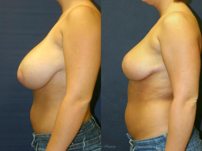 Before & After Breast Reduction Case 8728 View #2 View in Portage, Kalamazoo, Battle Creek, Michigan