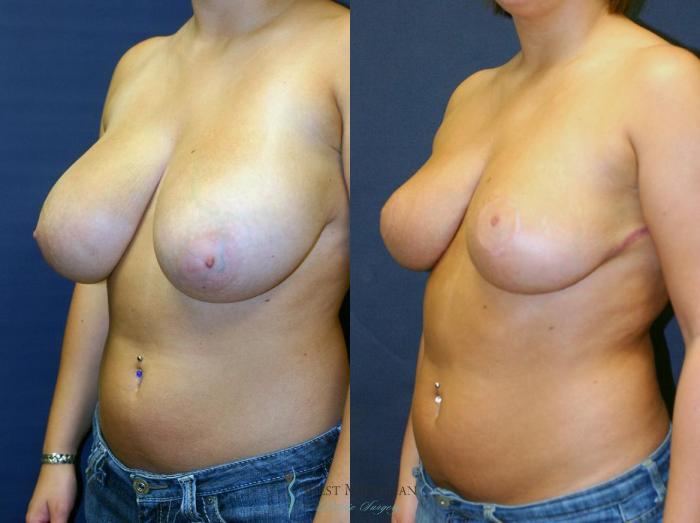 Before & After Breast Reduction Case 8728 View #3 View in Portage, Kalamazoo, Battle Creek, Michigan