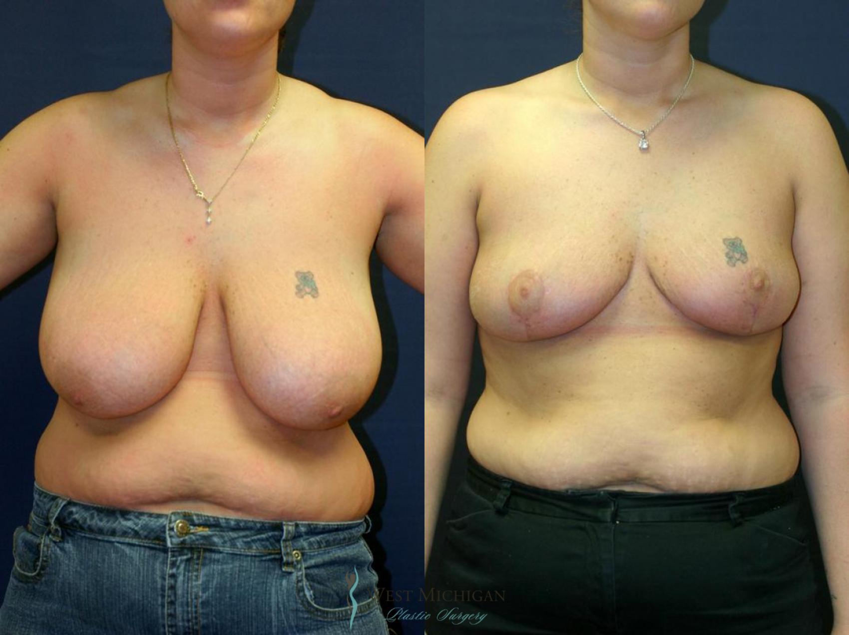Before & After Breast Reduction Case 9087 View #1 View in Portage, Kalamazoo, Battle Creek, Michigan