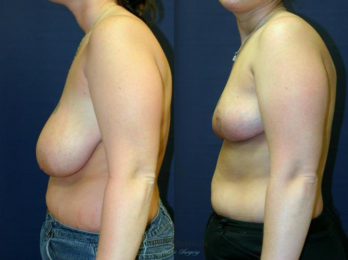 Before & After Breast Reduction Case 9087 View #2 View in Portage, Kalamazoo, Battle Creek, Michigan