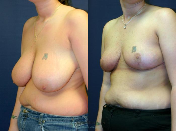 Before & After Breast Reduction Case 9087 View #3 View in Portage, Kalamazoo, Battle Creek, Michigan