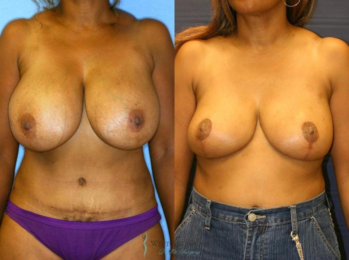 Before & After Breast Reduction Case 9102 View #1 View in Portage, Kalamazoo, Battle Creek, Michigan