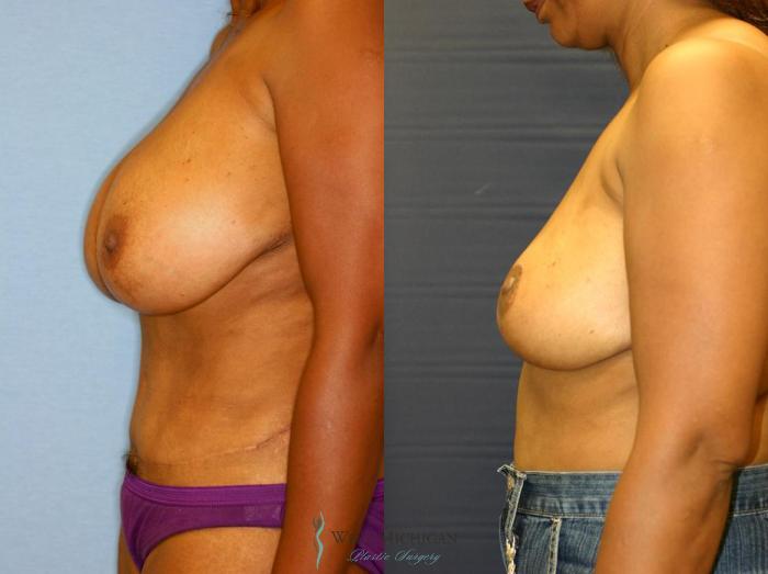 Before & After Breast Reduction Case 9102 View #2 View in Portage, Kalamazoo, Battle Creek, Michigan