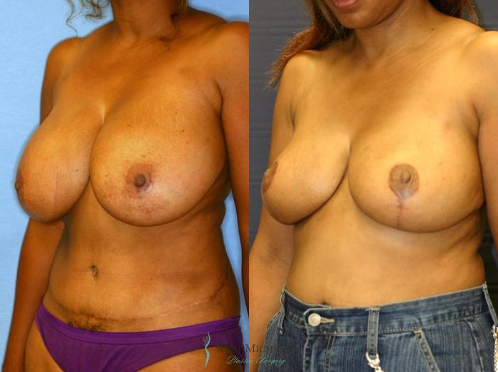 Before & After Breast Reduction Case 9102 View #3 View in Portage, Kalamazoo, Battle Creek, Michigan