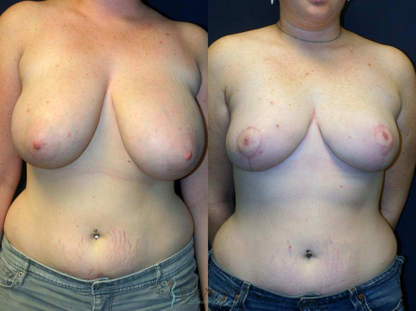 Before & After Breast Reduction Case 9109 View #1 View in Portage, Kalamazoo, Battle Creek, Michigan