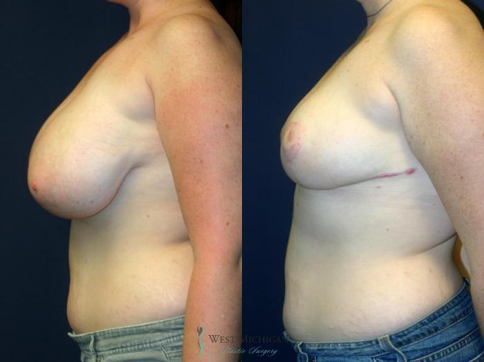 Before & After Breast Reduction Case 9109 View #2 View in Portage, Kalamazoo, Battle Creek, Michigan