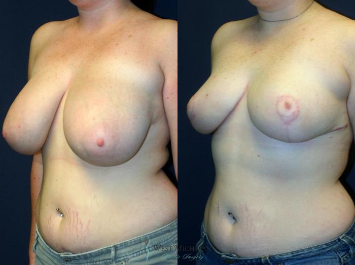 Before & After Breast Reduction Case 9109 View #3 View in Portage, Kalamazoo, Battle Creek, Michigan