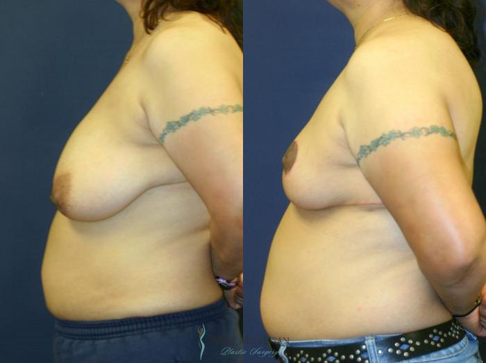 Before & After Breast Reduction Case 9117 View #2 View in Portage, Kalamazoo, Battle Creek, Michigan