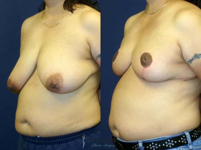 Before & After Breast Reduction Case 9117 View #3 View in Portage, Kalamazoo, Battle Creek, Michigan