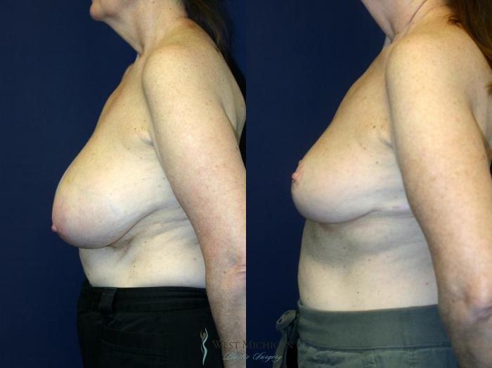 Before & After Breast Reduction Case 9118 View #2 View in Portage, Kalamazoo, Battle Creek, Michigan